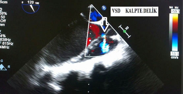 KALP DELİĞİ KAPALI AMELİYATLA TEDAVİ EDİLDİ