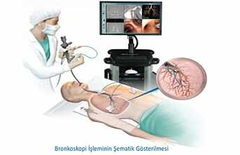 Devlet Hastanesi’ne Bronoskopi Cihazı