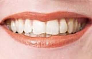 DİŞLERİNİZİ BEYAZLATMAK İSTERKEN SARATMAYIN